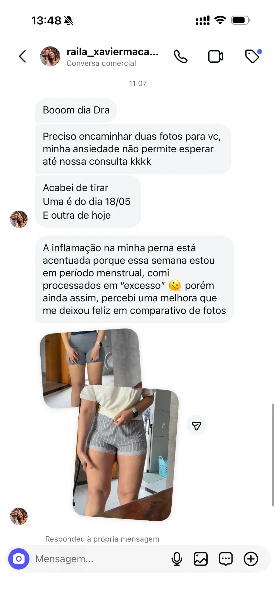 Paciente relata pernas menos inchadas durante o tratamento de lipedema